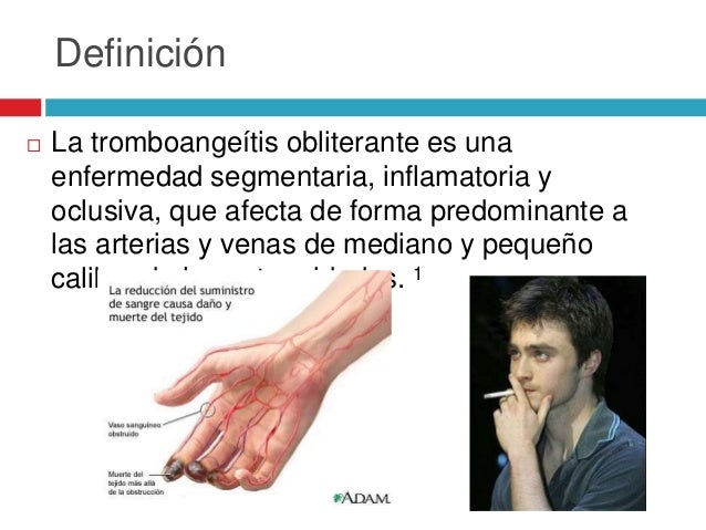 enfermedad buerger tromboangeitis obliterante